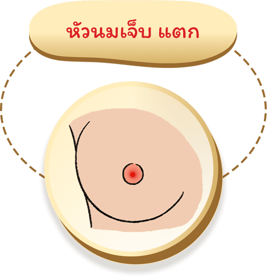 หัวนมเจ็บ แตก