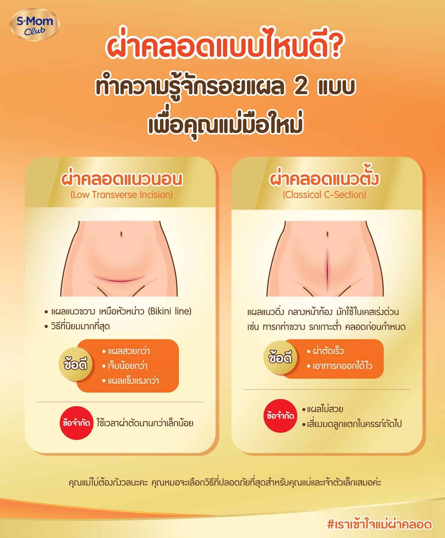 ผ่าคลอดแนวตั้ง vs แนวนอน ต่างกันอย่างไร