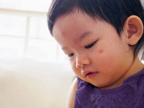 ภูมิแพ้ในเด็กเล็ก พร้อมวิธีดูแลลูก เมื่อเด็กเป็นภูมิแพ้