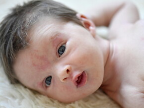 ผดร้อนทารก ลูกเป็นผื่นเม็ดเล็ก ๆ คัน ดูแลลูกแบบไหนให้ถูกวิธี