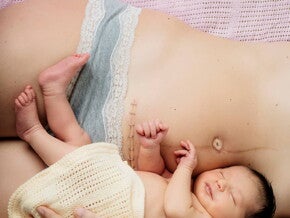 คันแผลผ่าคลอด ทำยังไงดี พร้อมวิธีแก้อาการคันแผลผ่าตัด