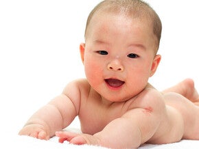 ผื่นแพ้อาหารทารกมีลักษณะอย่างไร รวมวิธีสังเกตและดูลูกน้อย