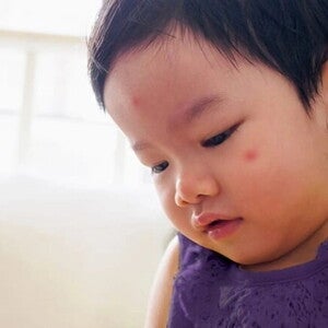 ภูมิแพ้ในเด็กเล็ก พร้อมวิธีดูแลลูก เมื่อเด็กเป็นภูมิแพ้