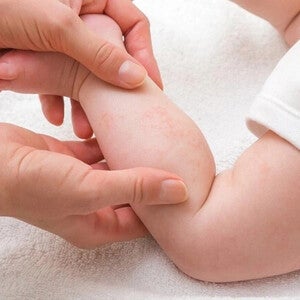 ผื่นในเด็กทารกเกิดจากอะไร มีลักษณะแบบไหน พร้อมวิธีการดูแลลูกน้อย