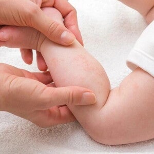 ลูกเป็นผื่นแดงทั้งตัว ปัญหาผื่นทารก พร้อมวิธีดูแลลูก