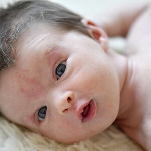 ผดร้อนทารก ลูกเป็นผื่นเม็ดเล็ก ๆ คัน ดูแลลูกแบบไหนให้ถูกวิธี