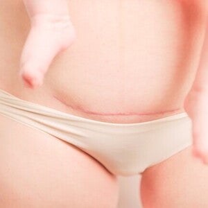 10 ข้อห้ามหลังผ่าคลอด ผ่าคลอดกี่ชั่วโมงเดินได้? วิธีดูแลแผลให้หายไว
