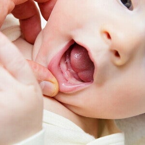 ลิ้นลูกเป็นฝ้าขาว คุณแม่ดูแลลูกลิ้นขาวอย่างไรให้ถูกวิธี