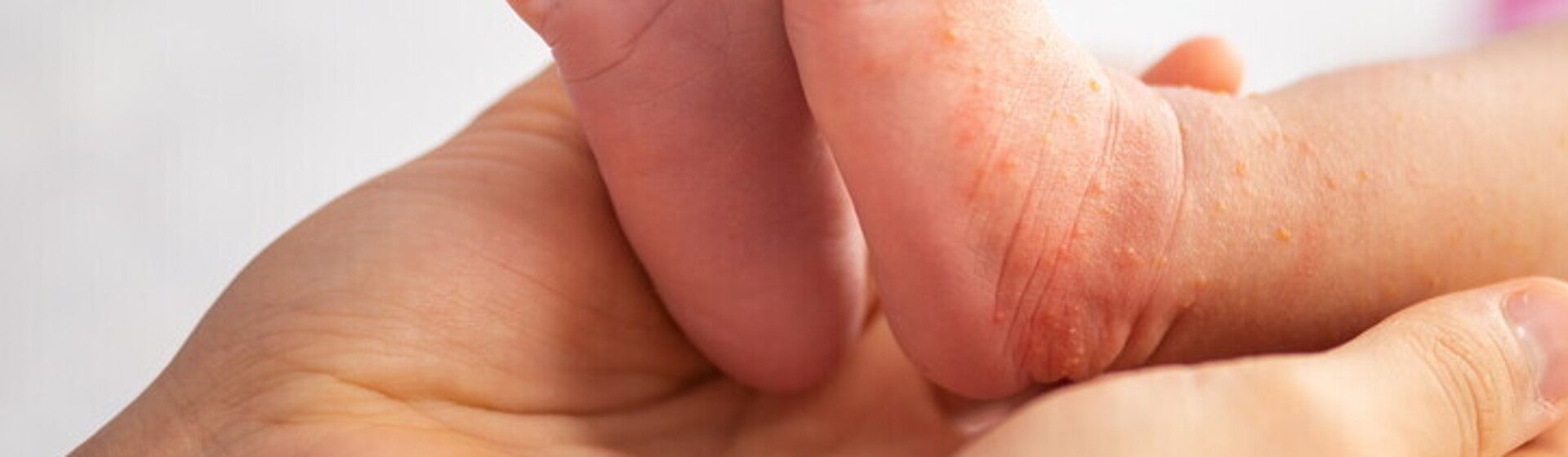 ลูกเป็นผื่นเม็ดเล็ก ๆ คัน สาเหตุที่พบบ่อย พร้อมวิธีรับมือที่ถูกต้อง