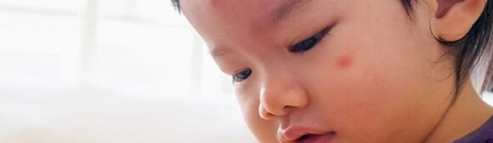 อาการภูมิแพ้ในเด็ก สาเหตุ อาการ พร้อมวิธีดูแลรักษาภูมิแพ้ในเด็ก อาการภูมิแพ้ในเด็ก สาเหตุ อาการ พร้อมวิธีดูแลรักษาภูมิแพ้ในเด็ก